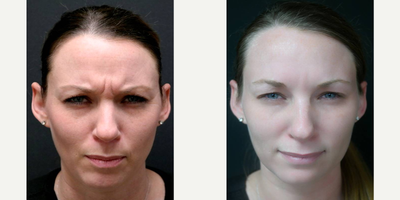 Botox before and after photo