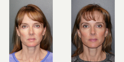 Deep Plane Facelift before and after photo