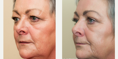 Eyelid Surgery before and after photo