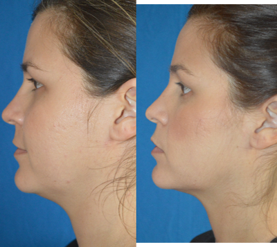 Kybella before and after photo