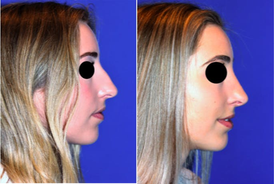 Rhinoplasty before and after photo