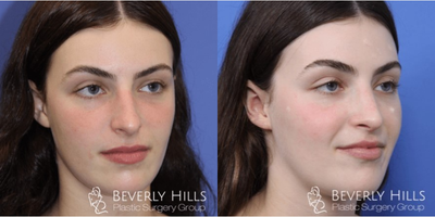 Rhinoplasty before and after photo