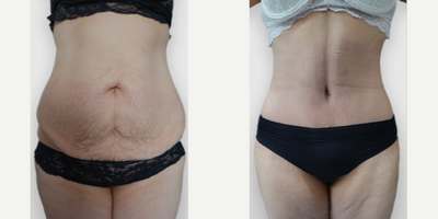 Tummy Tuck before and after photo