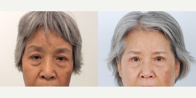 Brow Lift before and after photo