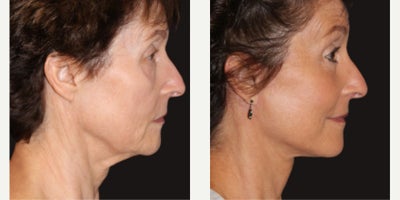 Brow Lift before and after photo