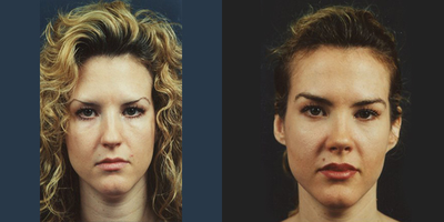 Lip Fillers before and after photo