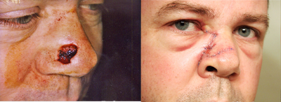 Mohs Surgery before and after photo