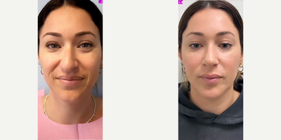 Rhinoplasty before and after photo