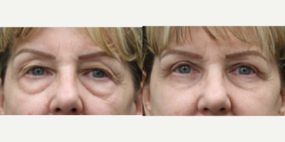 Eyelid Surgery before and after photo