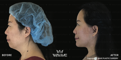 Facelift before and after photo