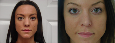 Rhinoplasty before and after photo