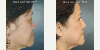 Rhinoplasty before and after photo