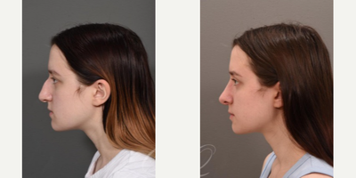 Rhinoplasty before and after photo