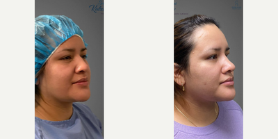 Rhinoplasty before and after photo
