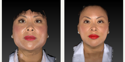 Ultherapy before and after photo