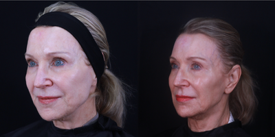 Botox for TMJ before and after photo