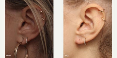 Earlobe Repair before and after photo