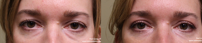 Eyelid Surgery before and after photo