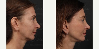 Facelift before and after photo