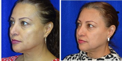 before and after image