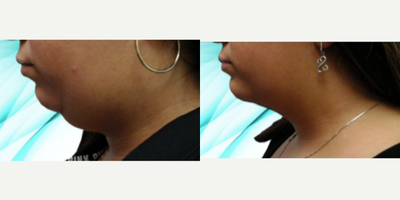 Lipodissolve before and after photo