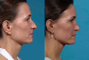 Rhinoplasty before and after photo