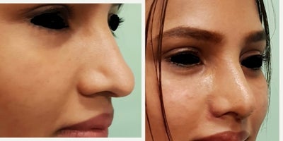 Rhinoplasty before and after photo