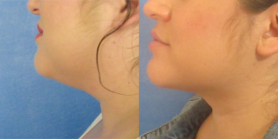 Smart Lipo before and after photo