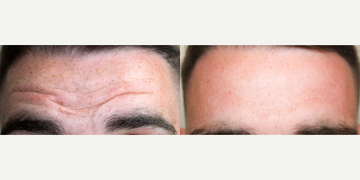 Botox before and after photo
