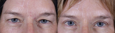 Eyelid Surgery before and after photo