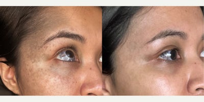 PicoSure before and after photo