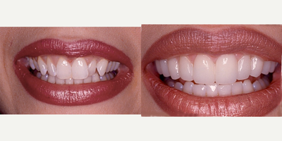 Porcelain Veneers before and after photo