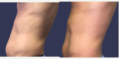truFlex before and after photo