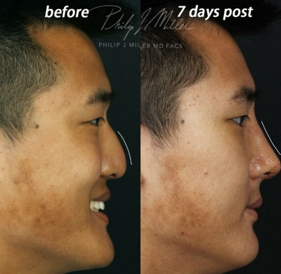 Asian Rhinoplasty before and after photo