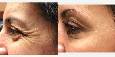 Botox before and after photo