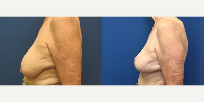 Breast Lift before and after photo