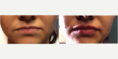 Dermal Fillers before and after photo