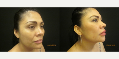 Eyelid Surgery before and after photo