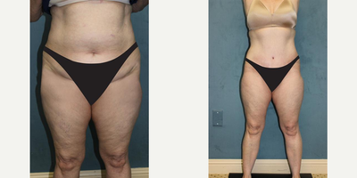 Liposuction before and after photo