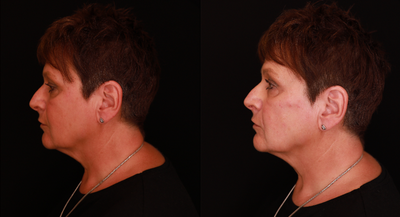 Nonsurgical Facelift before and after photo