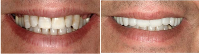 Porcelain Veneers before and after photo