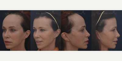 Brow Lift before and after photo
