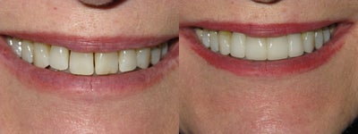 Porcelain Veneers before and after photo