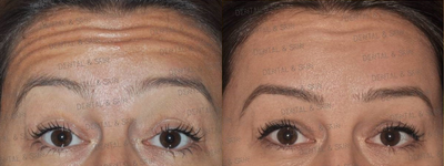 Botox before and after photo