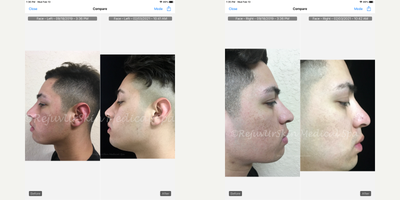 Laser Genesis before and after photo