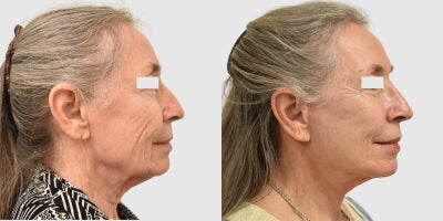 Neck Lift before and after photo