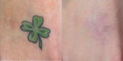 PicoSure before and after photo