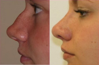 Rhinoplasty before and after photo