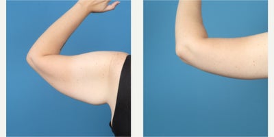 Arm Lift before and after photo