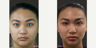 Botox before and after photo